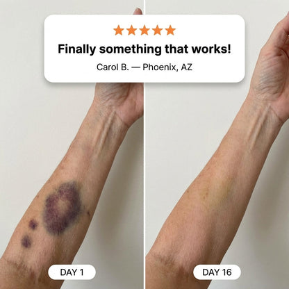 💥100K+ SOLD💕- Creawel® Bruise Repair & Skin-Strengthening Cream